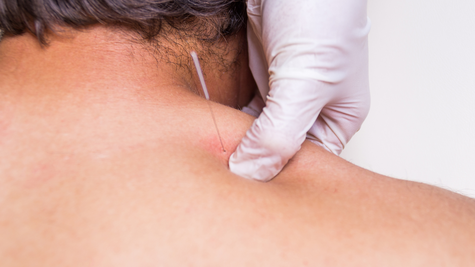 Dry Needling Physiotherapy